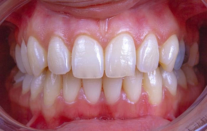 Close-up smile showing dental exam of tooth spacing