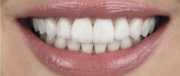 Clear Aligners — after treatment at Sri Ramachandra Dental Hospital