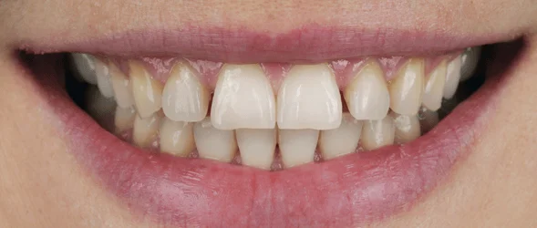 Clear Aligners — before treatment at Sri Ramachandra Dental Hospital
