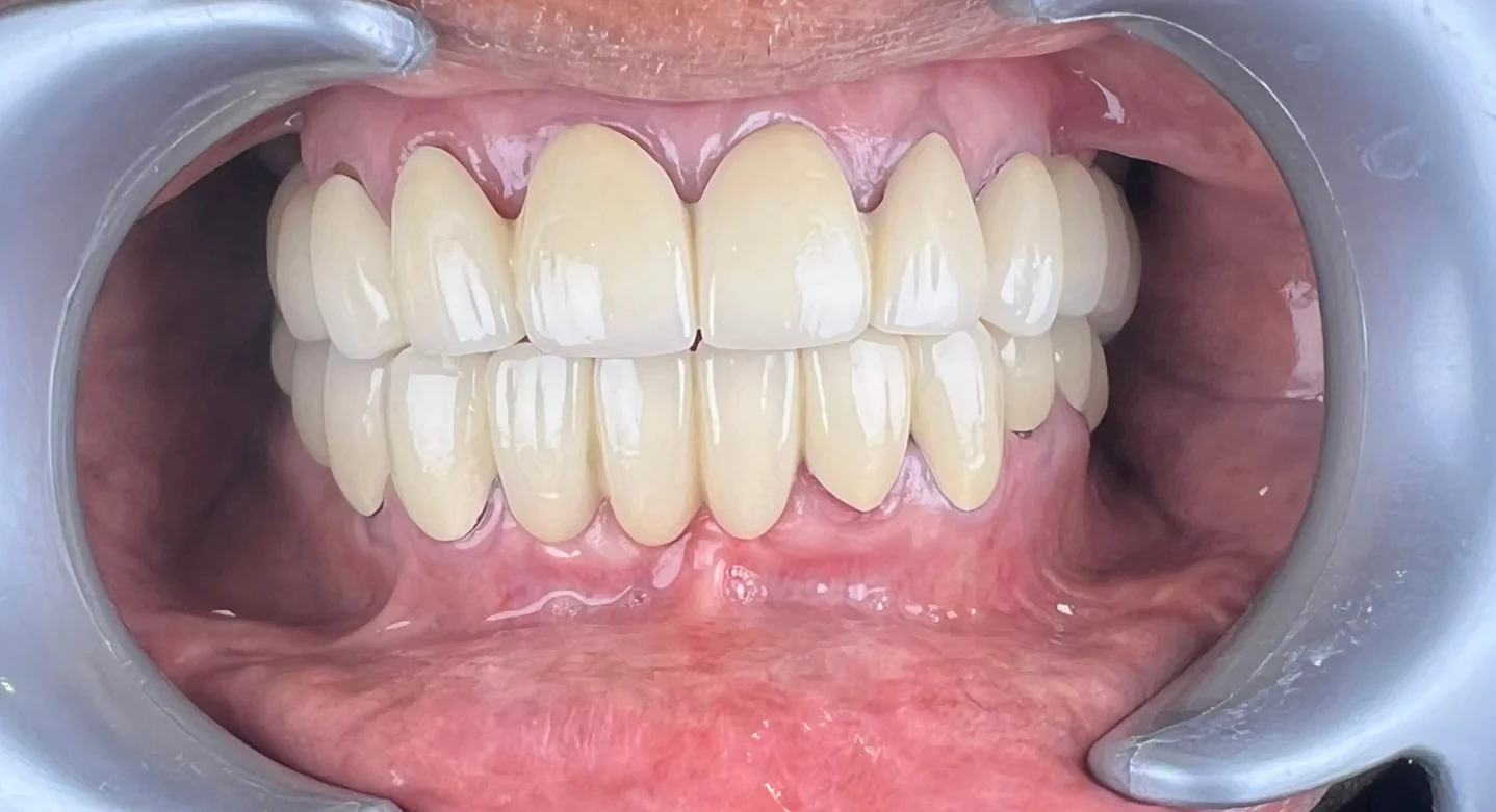Dental Implants — after treatment at Sri Ramachandra Dental Hospital