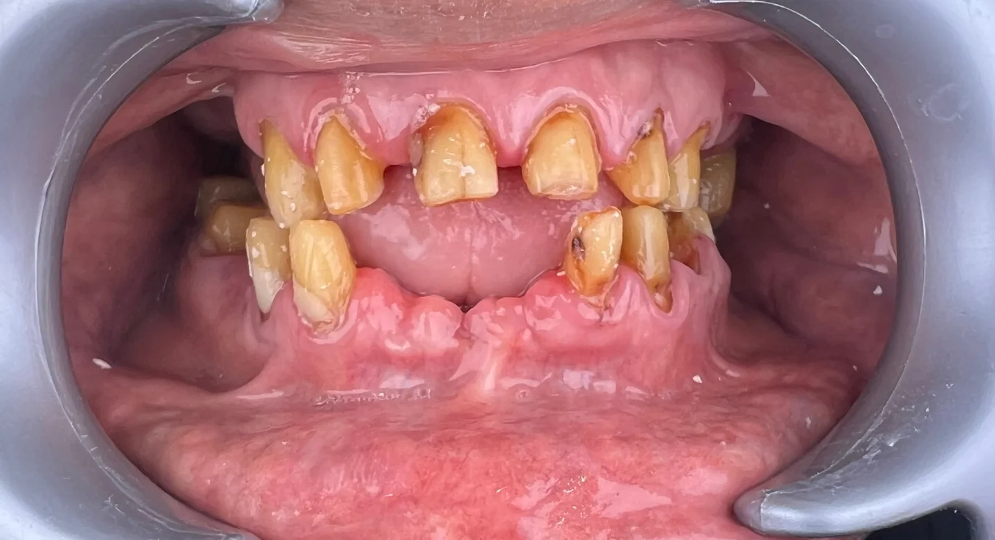 Dental Implants — before treatment at Sri Ramachandra Dental Hospital