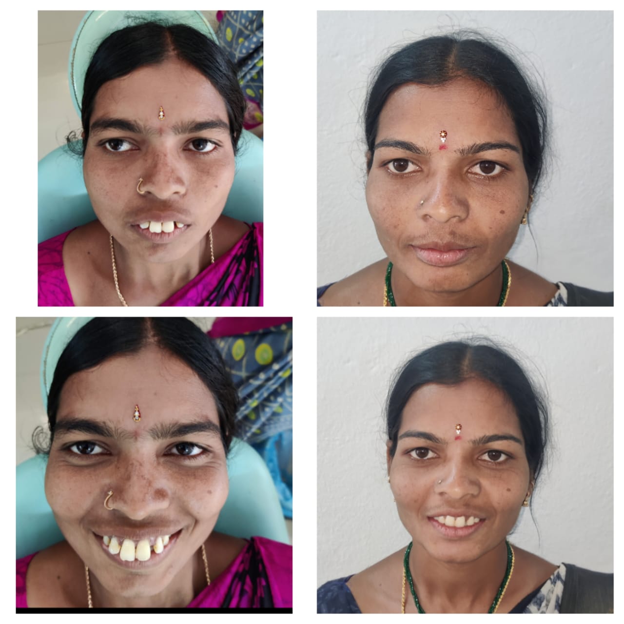 Smile Transformation — Before & After