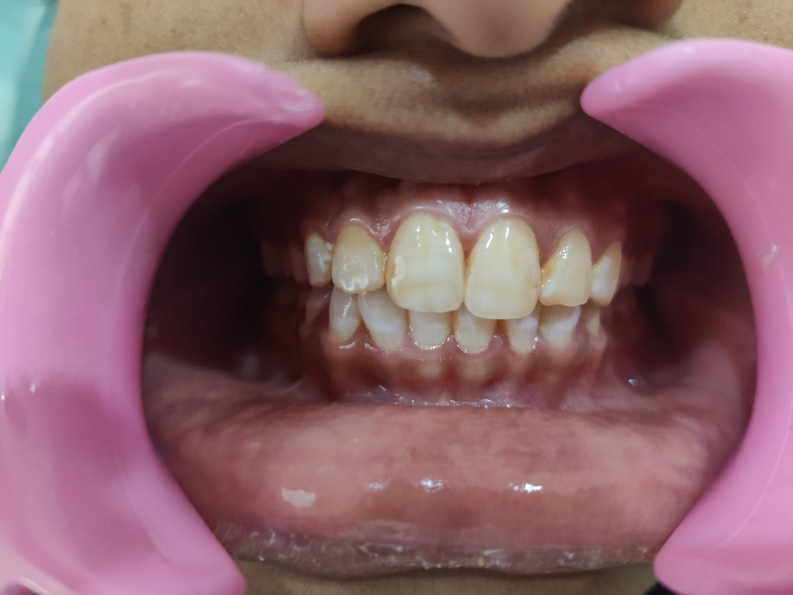 Dental Examination — Teeth Close-up
