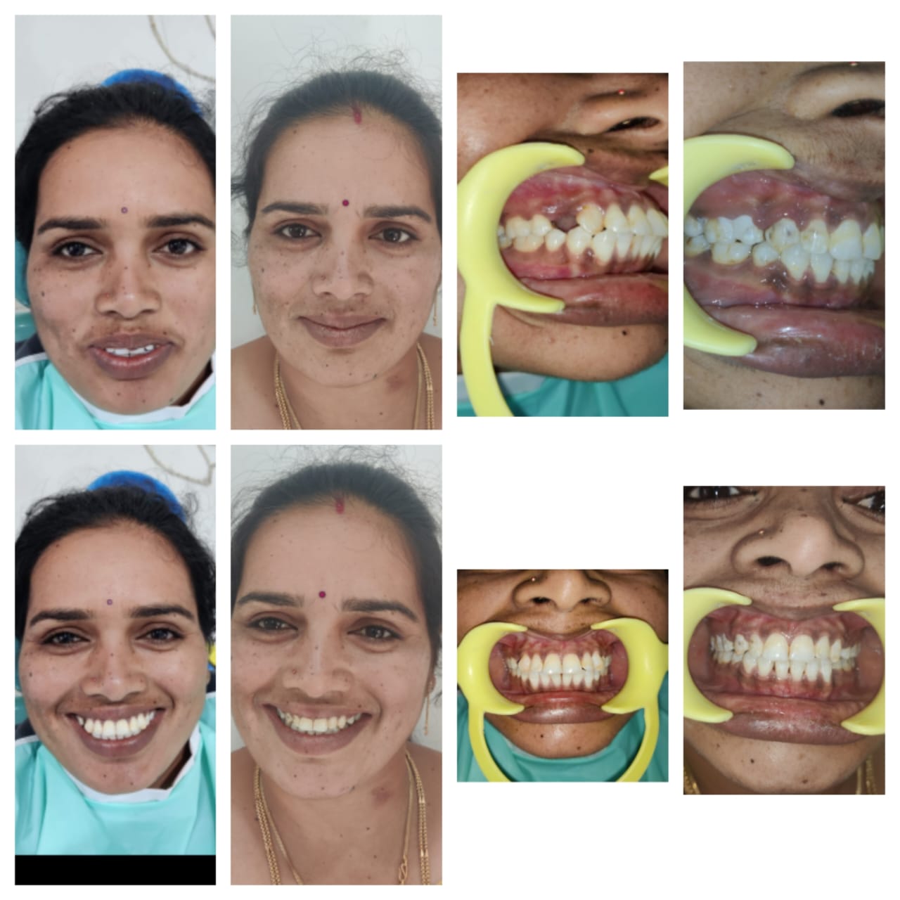 Full Case — Face & Teeth Before & After