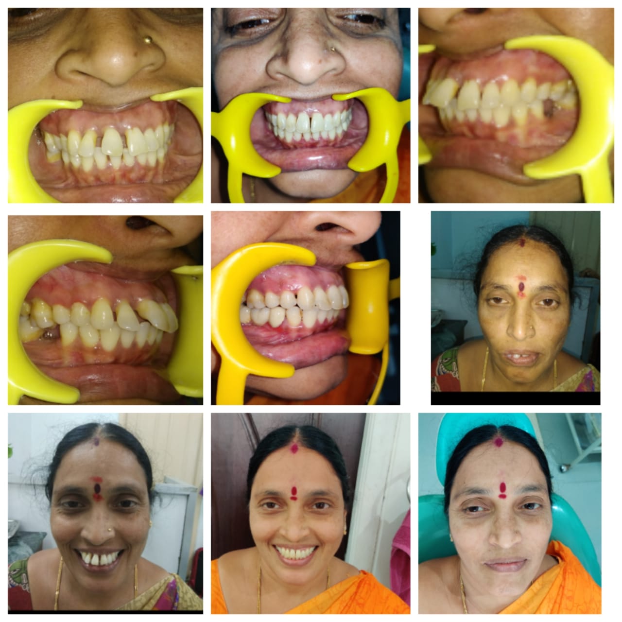 Dental Restoration Journey