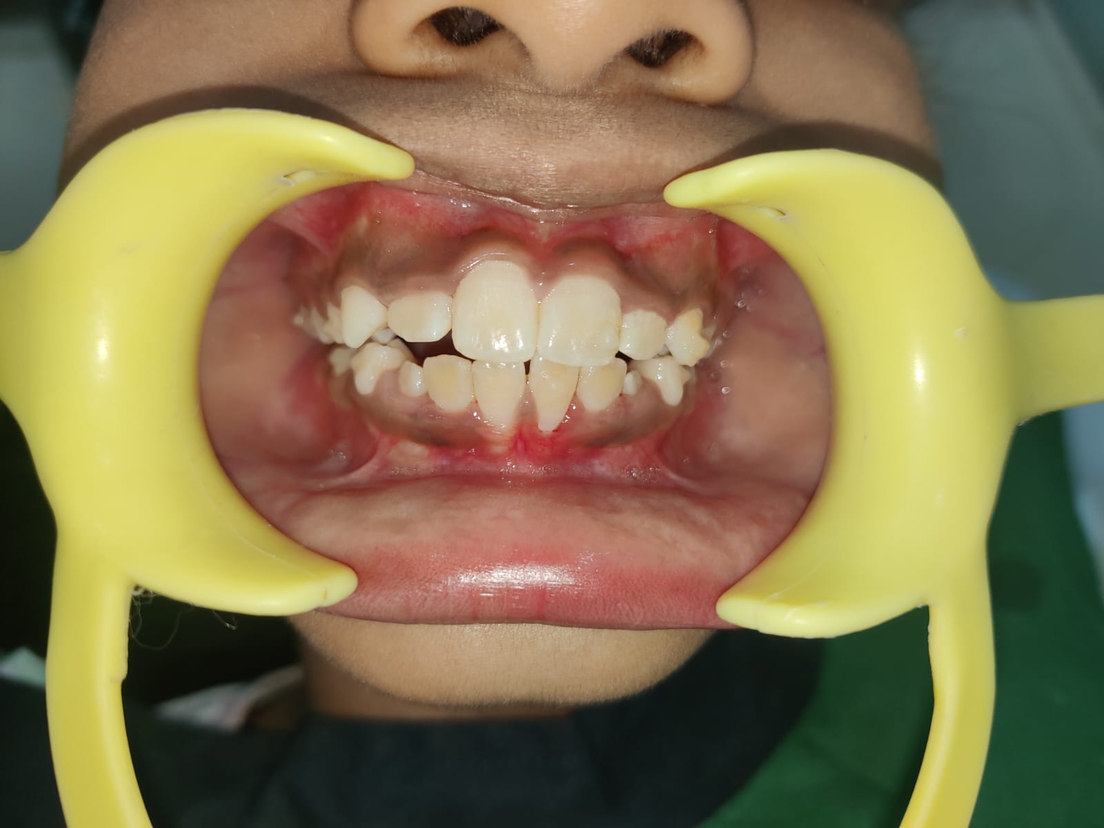 Malocclusion Evaluation