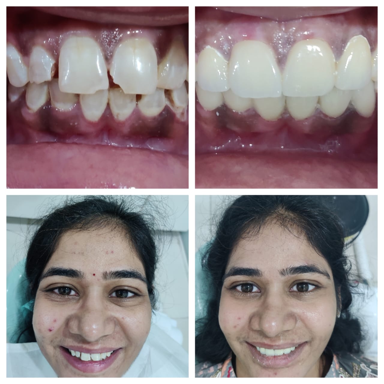Gap Closure — Before & After