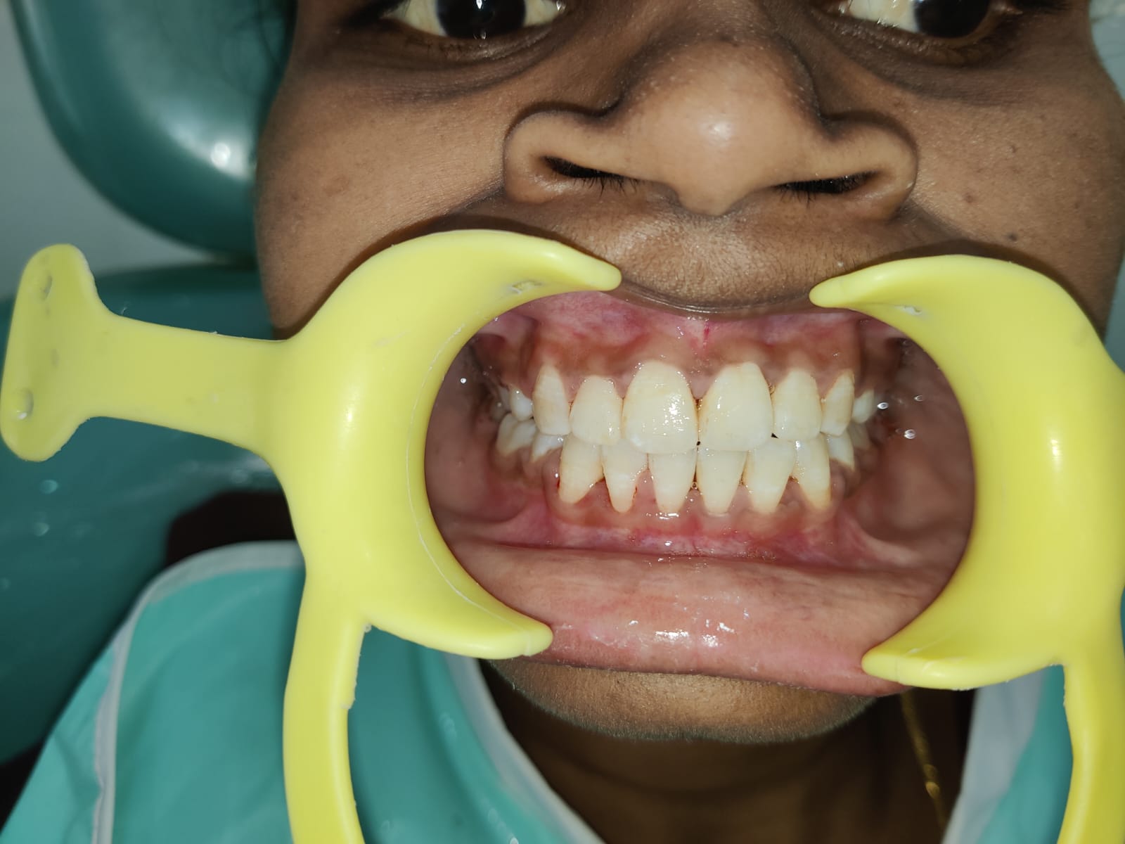 Clinical Teeth Examination