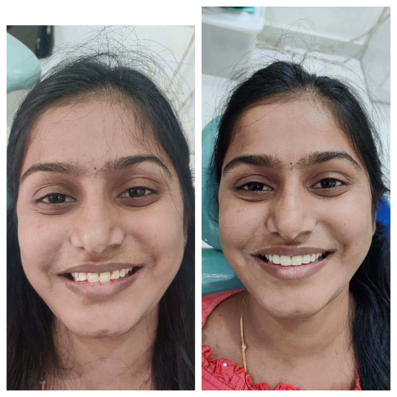Smile Makeover — Before & After
