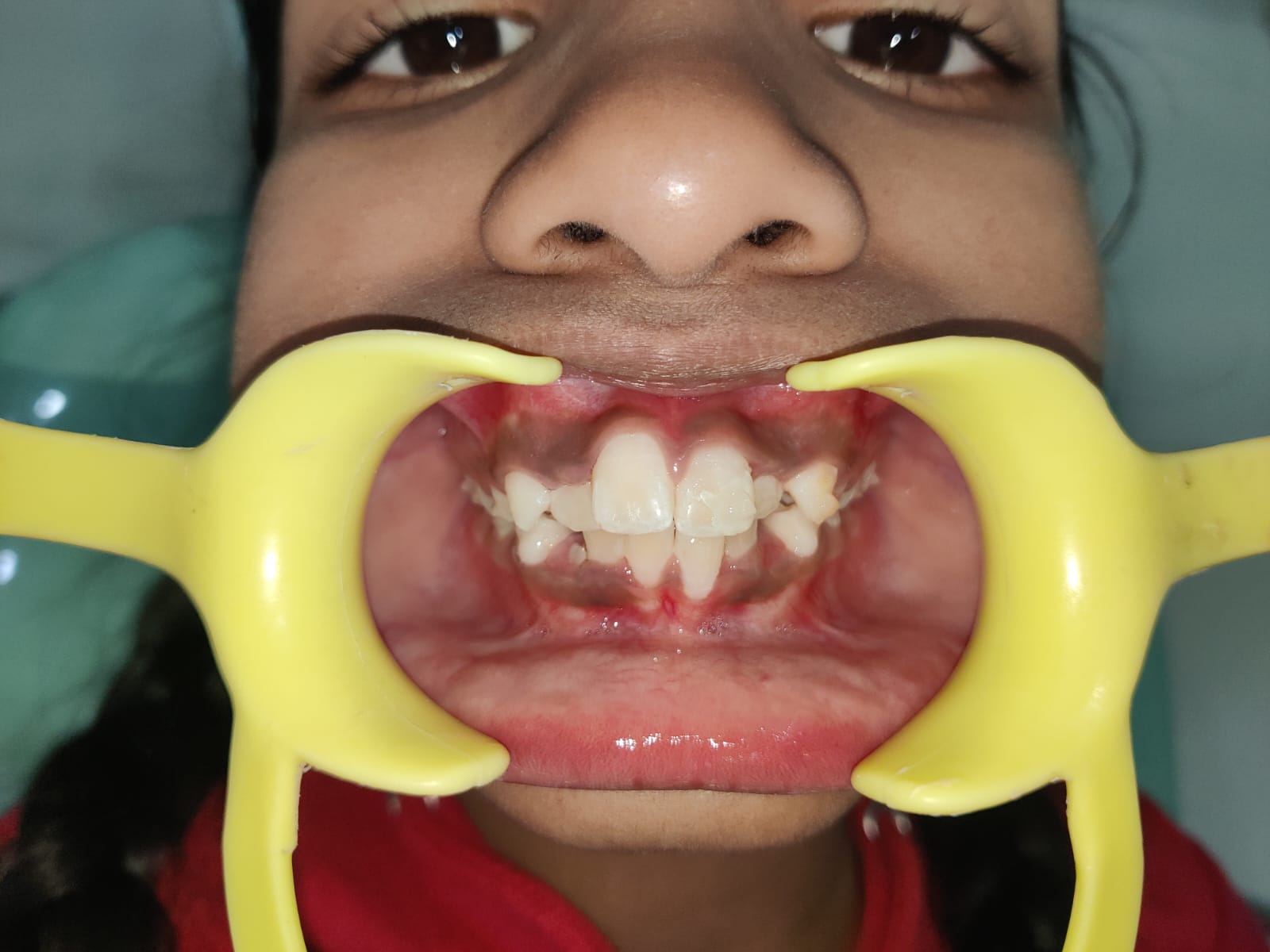 Crowded Teeth Assessment
