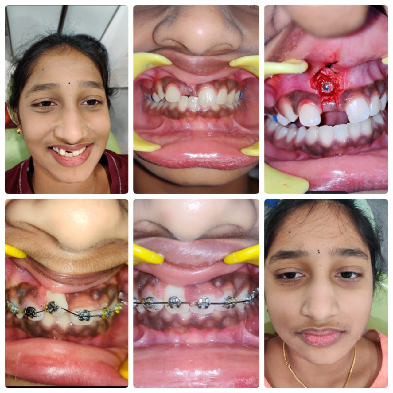 Orthodontic Braces Journey