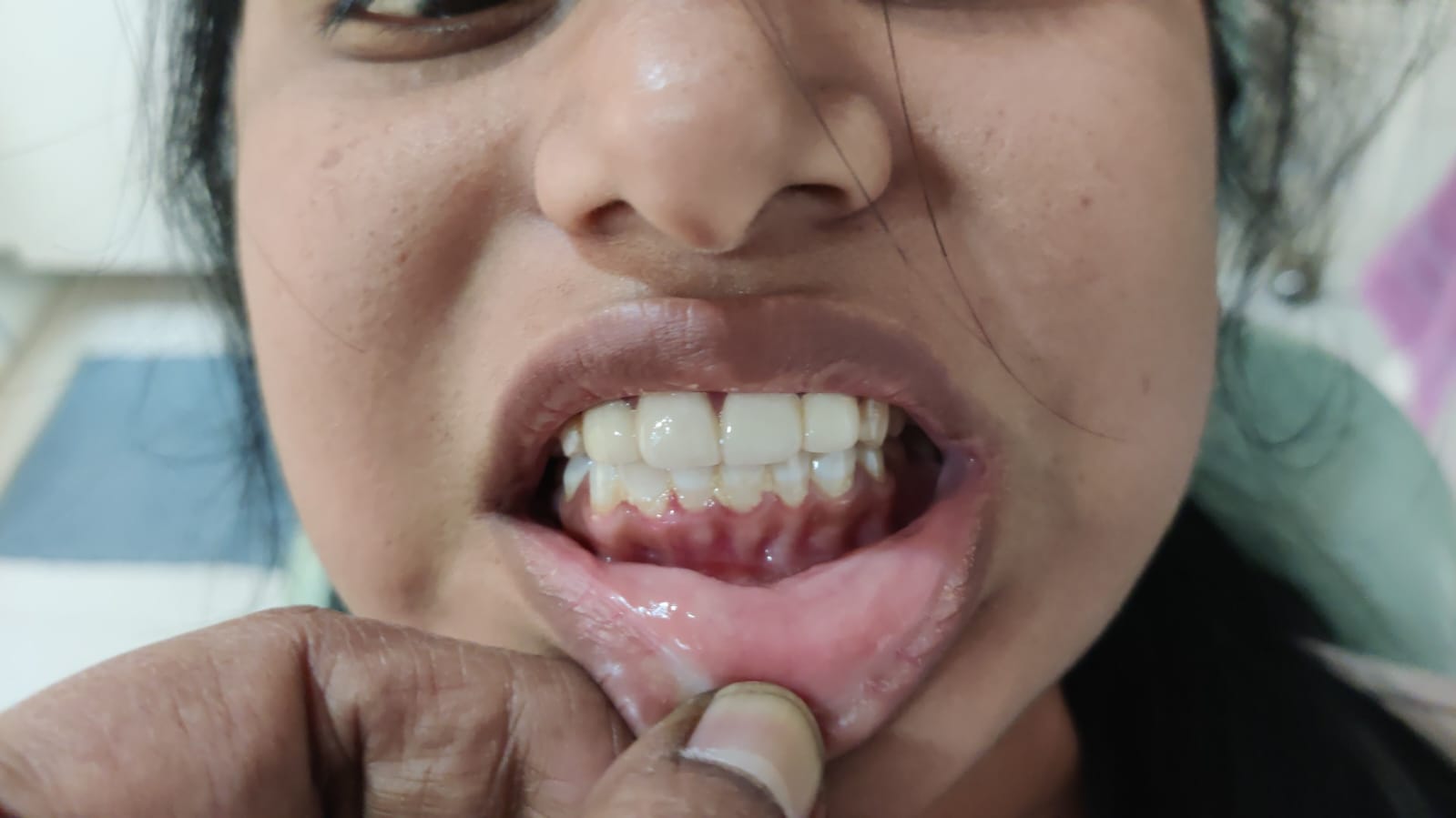 Post-Treatment Teeth Alignment