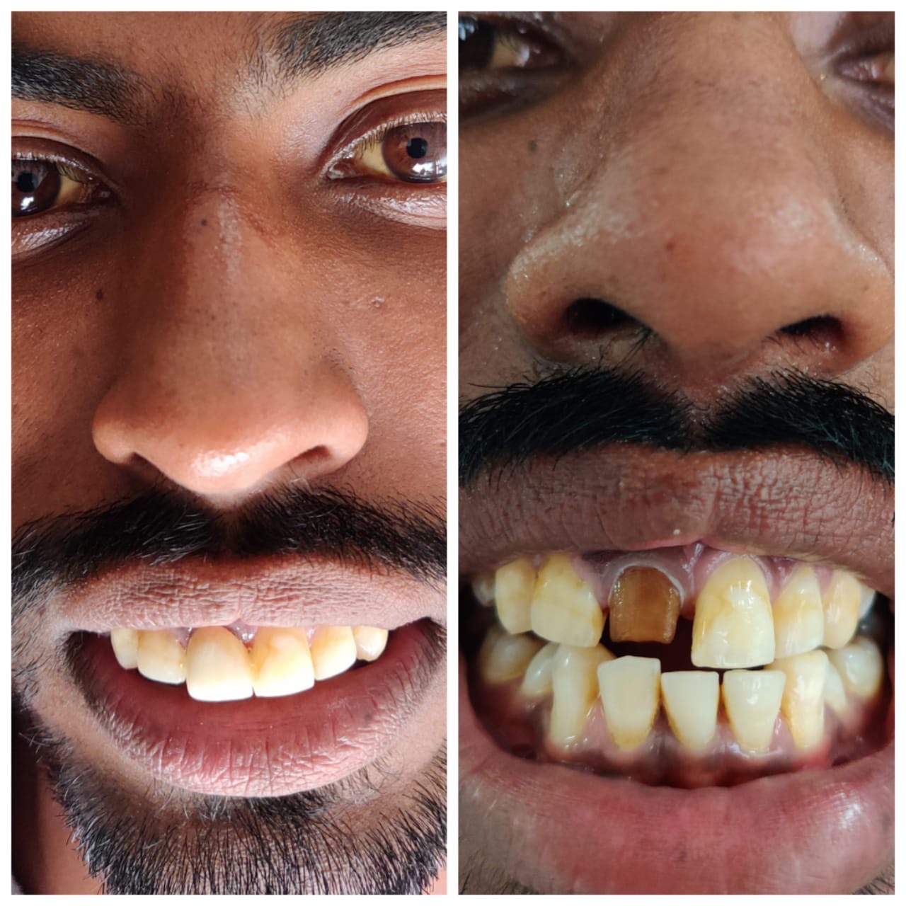 Teeth Repair — Before & After