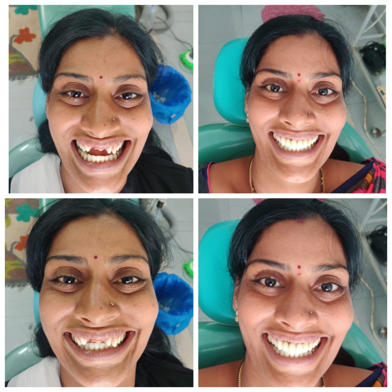 Missing Teeth Restored — Before & After